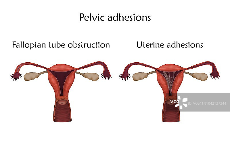 盆腔粘连图解图片素材