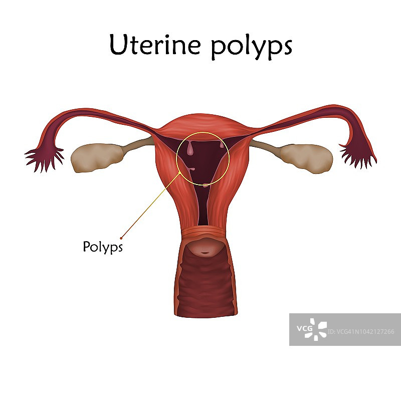 子宫息肉插图图片素材