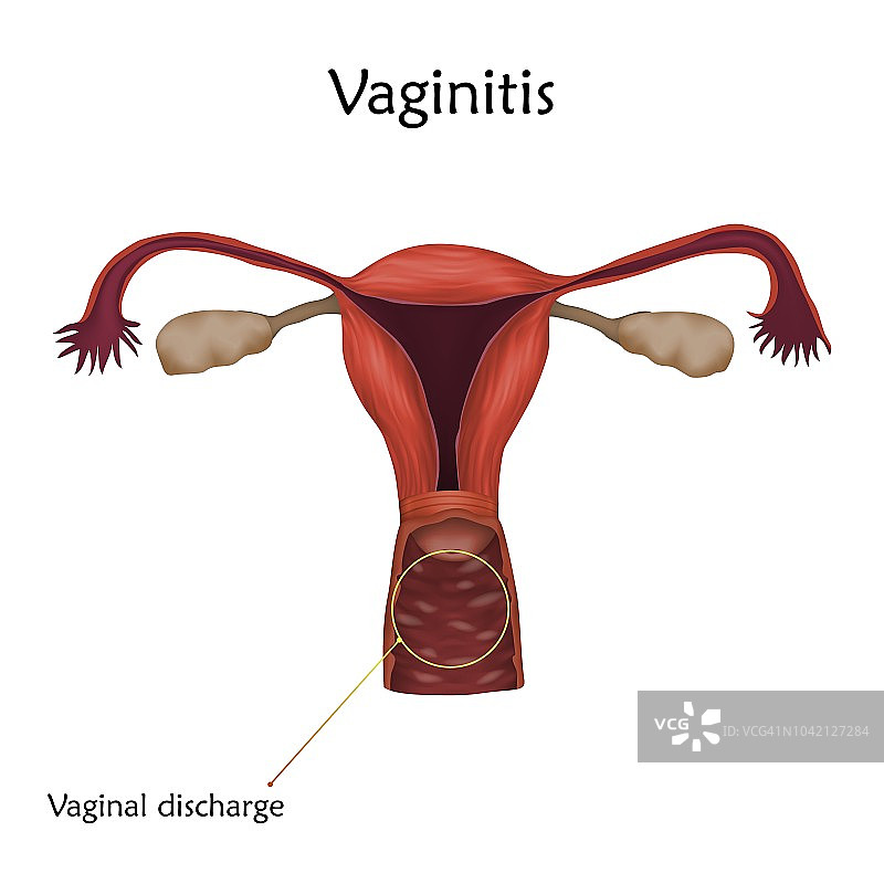 阴道炎插图图片素材