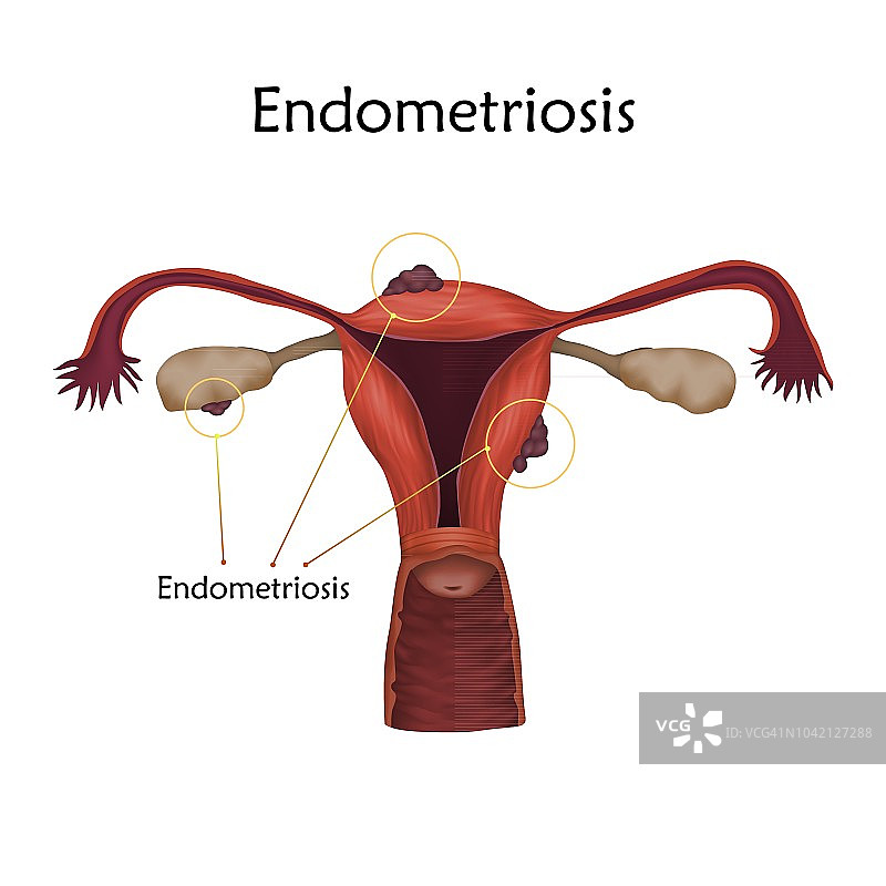 子宫内膜异位症图示图片素材