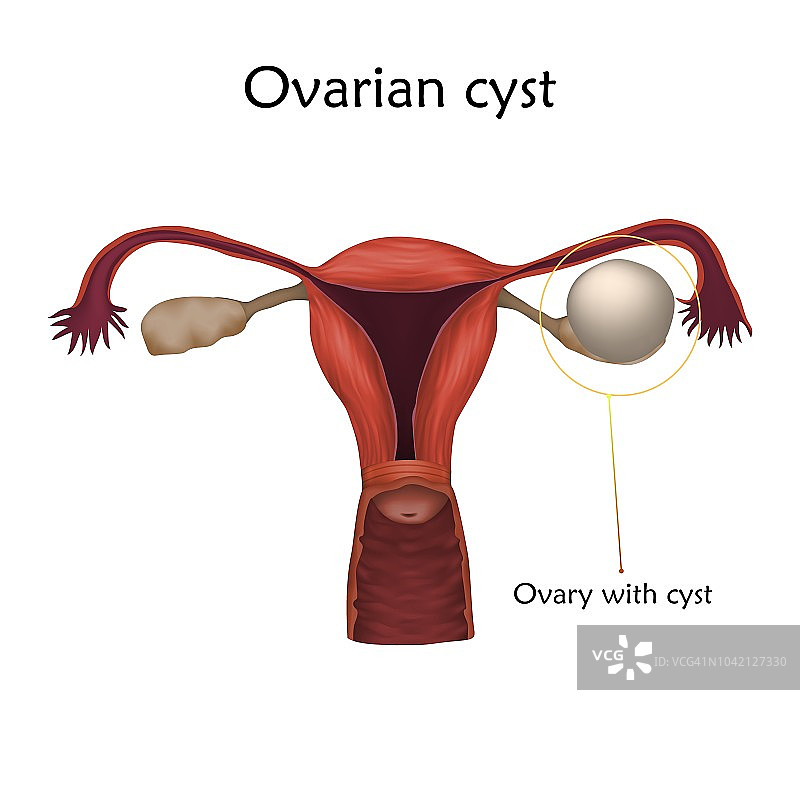 卵巢囊肿插图图片素材