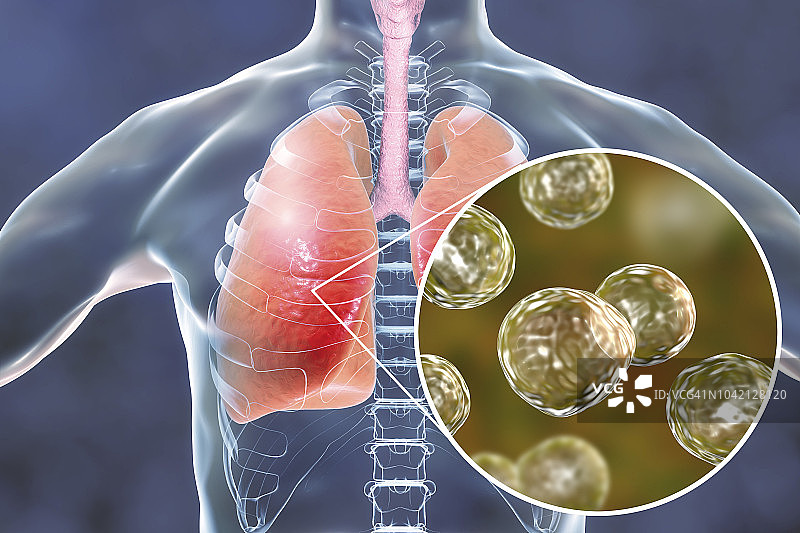 肺 blastomyces 菌病概念图图片素材