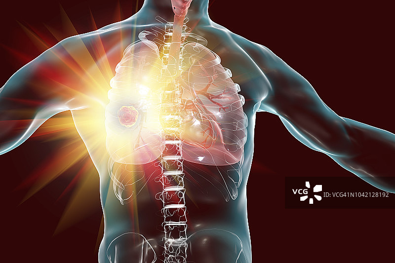 肺癌的治疗和预防概念插图图片素材