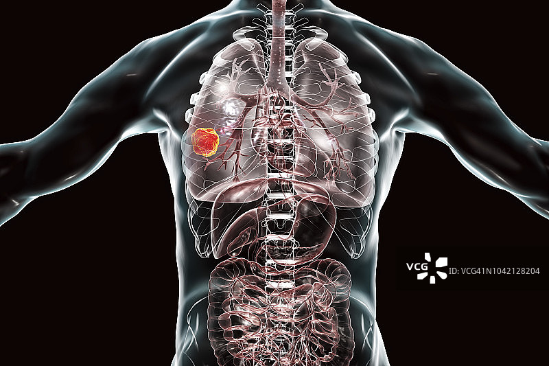 肺癌插图图片素材