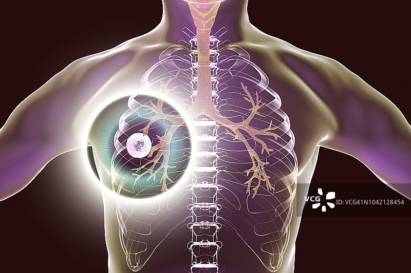 肺结核的治疗与预防图片素材
