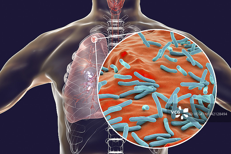 继发性肺结核感染插图图片素材