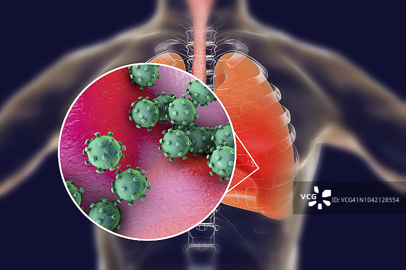病毒性肺炎，概念图图片素材