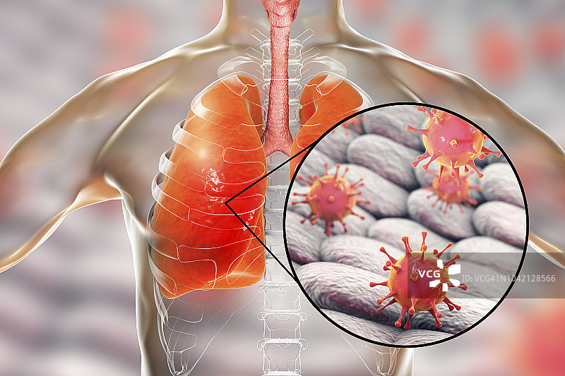 病毒性肺炎，概念图图片素材