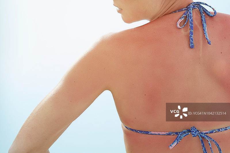 背部晒伤的女人图片素材