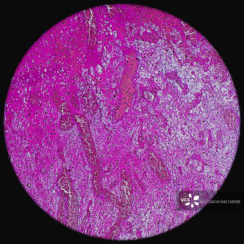 显微镜下的血管瘤肿瘤图片素材
