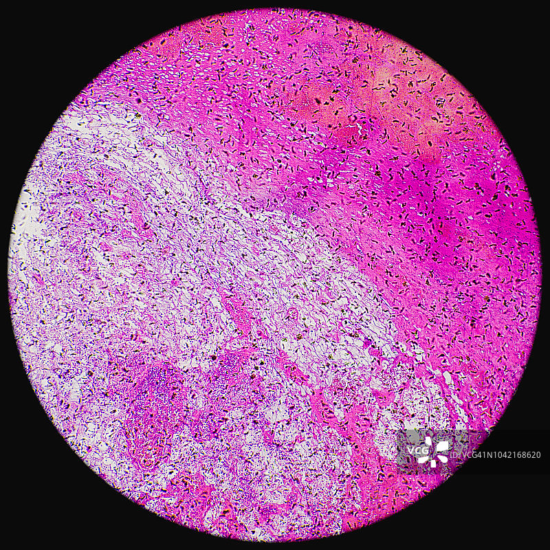 显微镜下的血管瘤肿瘤图片素材