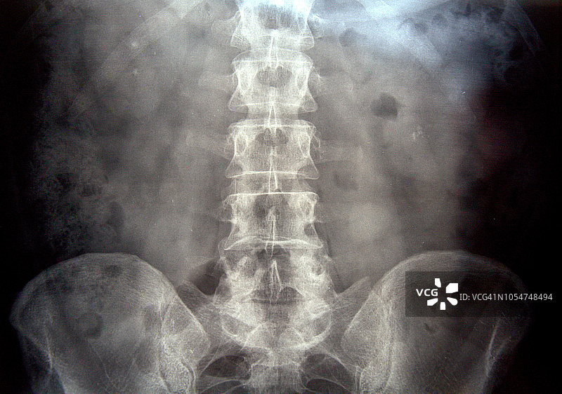 腹部X光射线照相图片素材