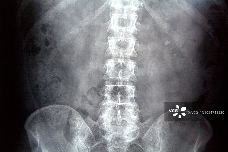 腹部X光射线照相图片素材