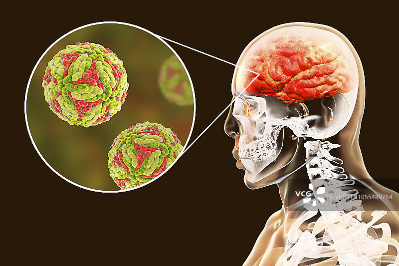 日本脑炎插图图片素材