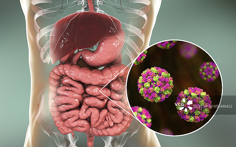 诺如病毒感染，图示图片素材