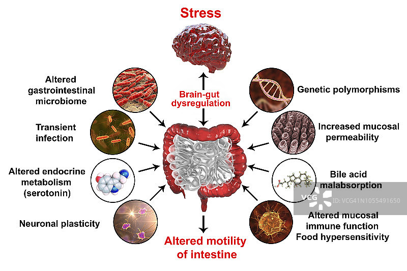 肠易激综合征插图图片素材