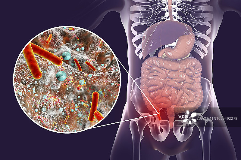 阑尾炎插图图片素材