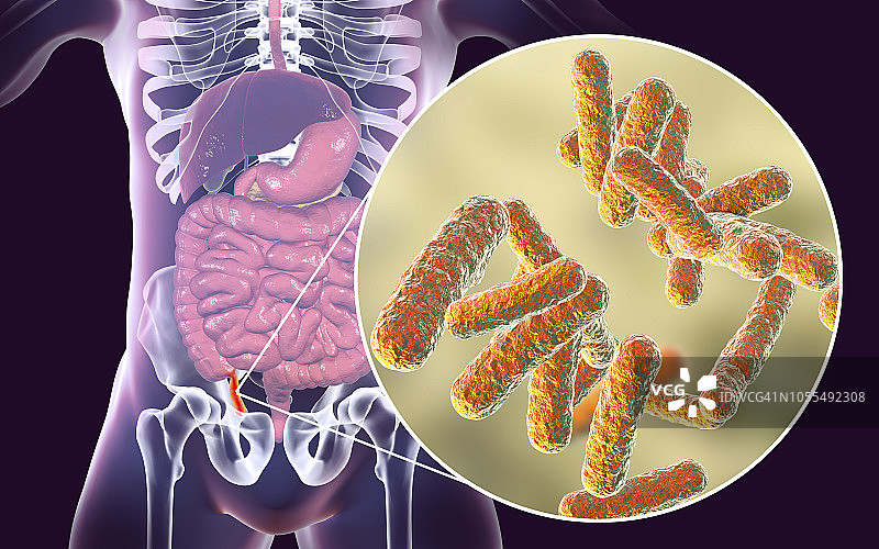 阑尾炎插图图片素材