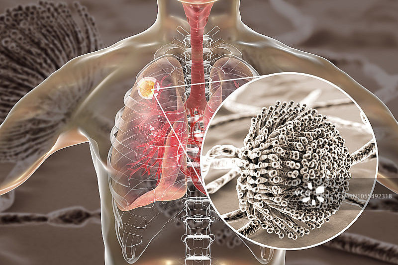 肺曲霉菌球，图示图片素材