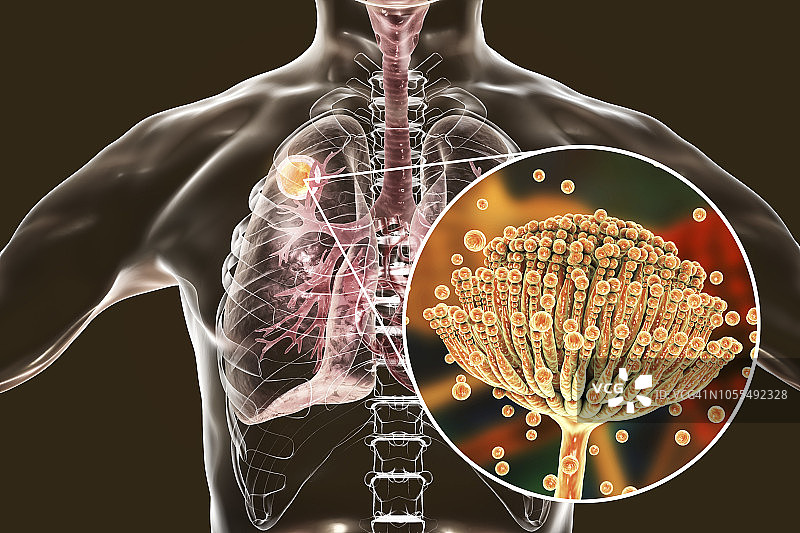 肺曲霉菌球，图示图片素材
