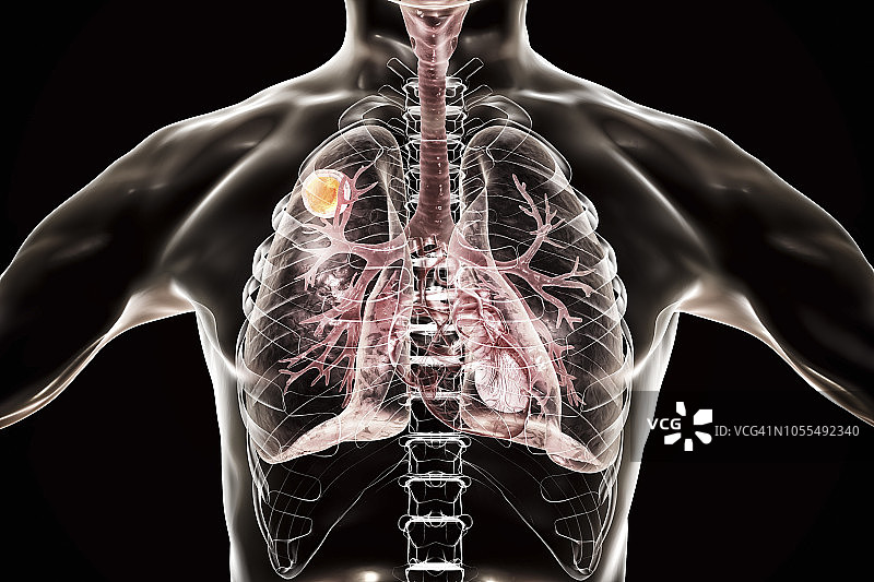 肺曲霉菌球，图示图片素材