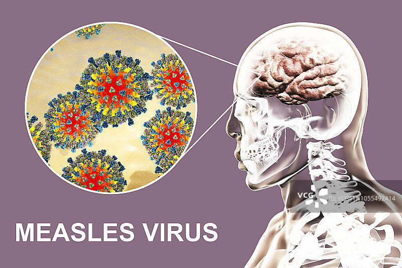 麻疹病毒引起的脑炎插图图片素材
