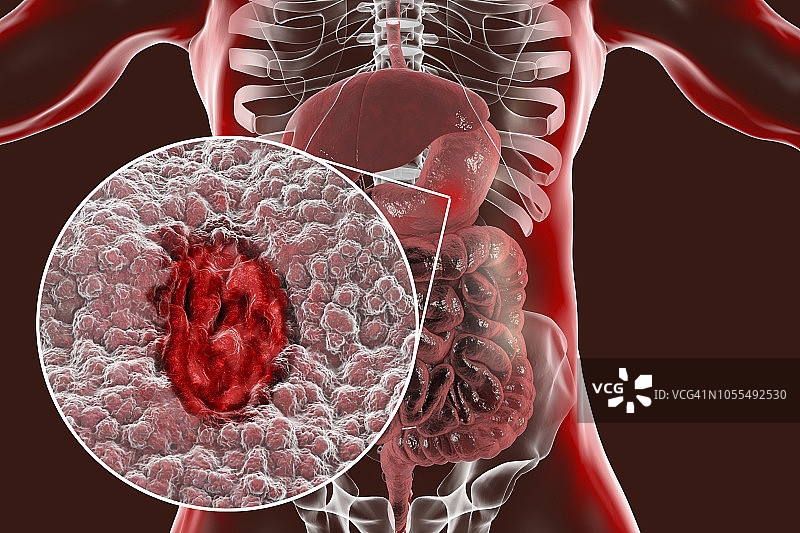 胃溃疡插图图片素材