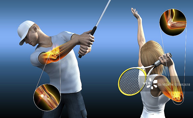 运动损伤肘部插画图片素材