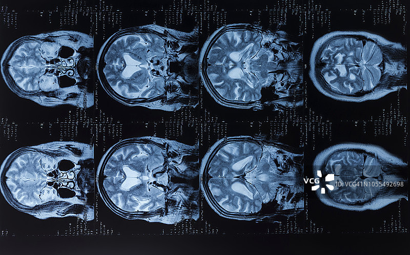 人脑MRI扫描图片素材
