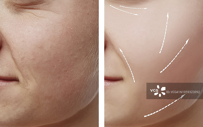 女孩除皱前后的面部对比图片素材