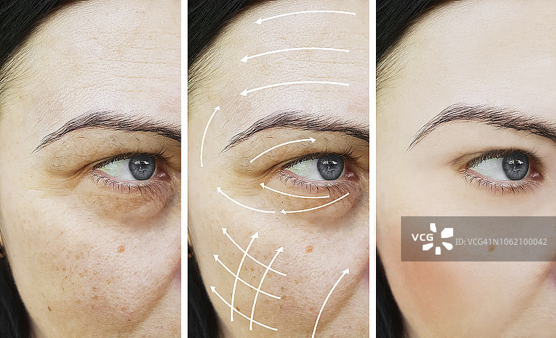 女性面部皱纹矫正前后对比图片素材