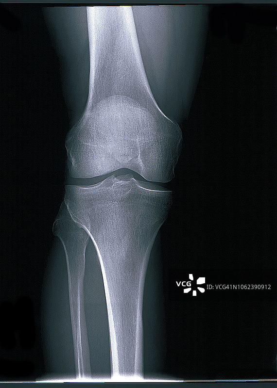 膝关节正面X光片图片素材