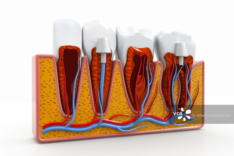 牙齿种植过程图片素材