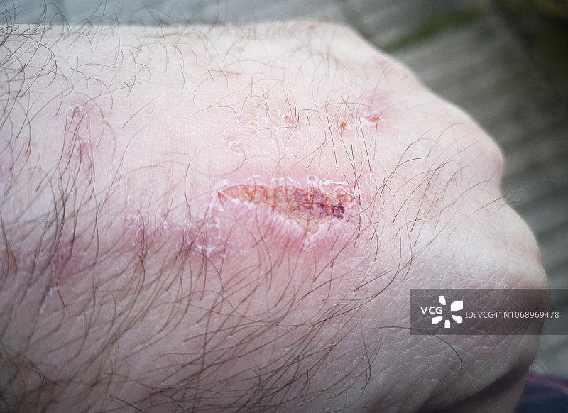 手部伤口图片素材