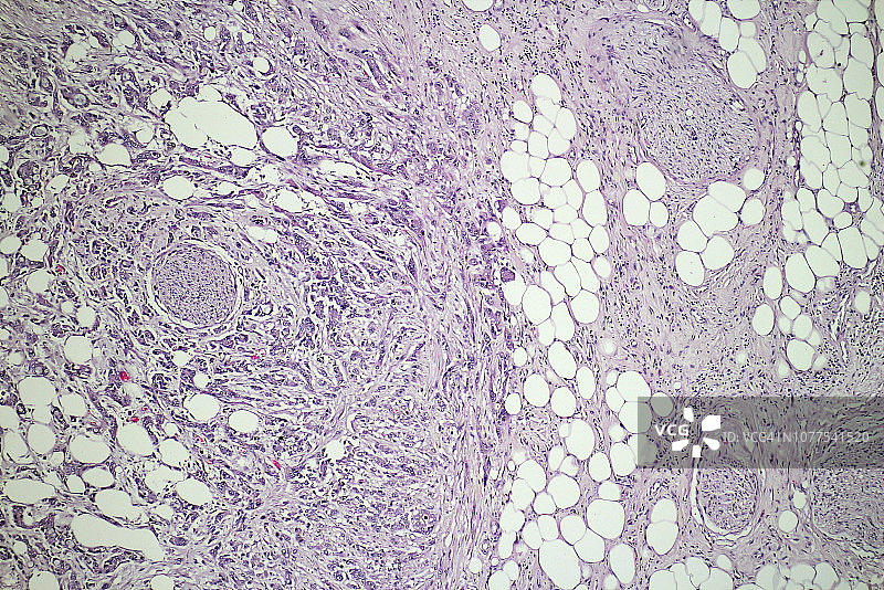 胰腺癌腹部脂肪、腹膜转移鳞状细胞癌微观照片，组织病理学图片素材