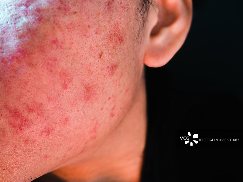 面部过敏性皮炎图片素材