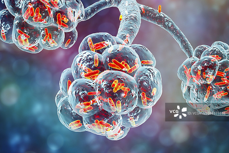 细菌性肺炎插图图片素材