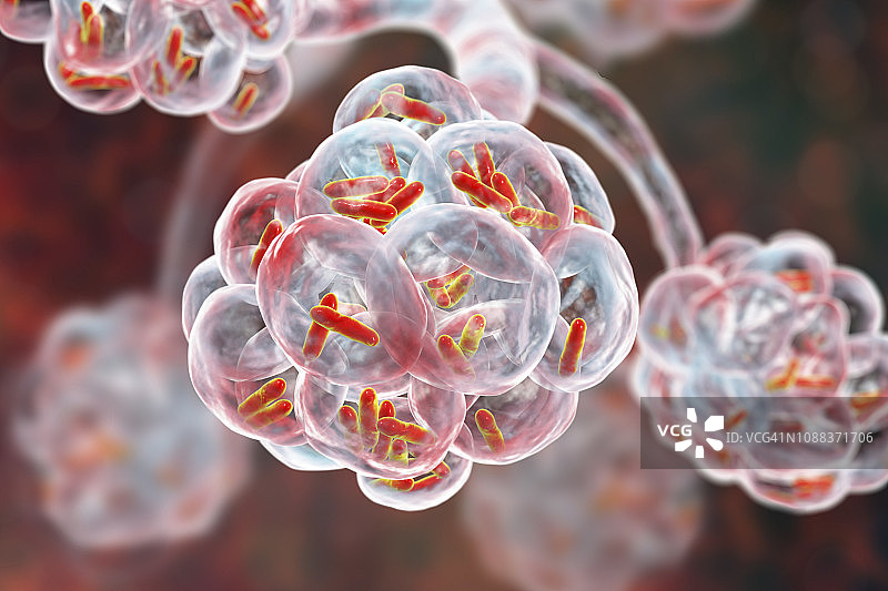 细菌性肺炎插图图片素材