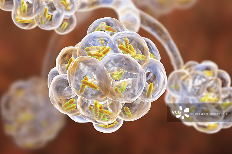 细菌性肺炎插图图片素材