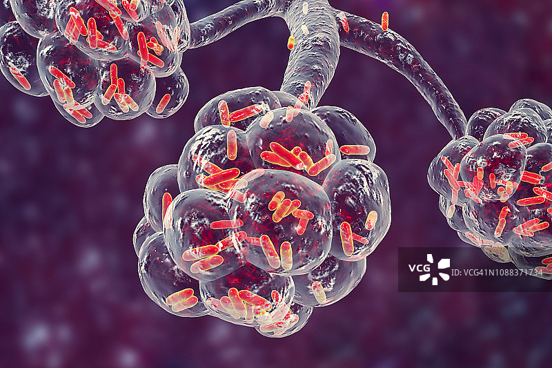 细菌性肺炎插图图片素材