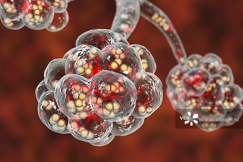 肺炎球菌性肺炎插图图片素材