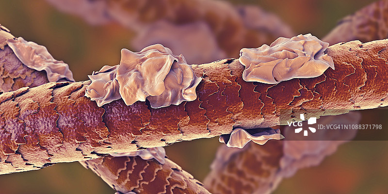 有头皮屑的人类头发插图图片素材