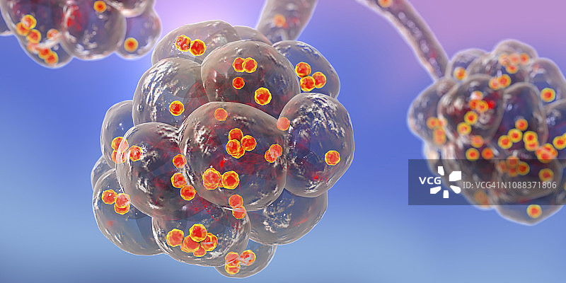 葡萄球菌肺炎，图示图片素材