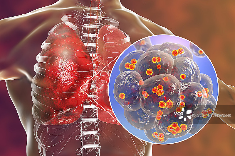 葡萄球菌肺炎，图示图片素材