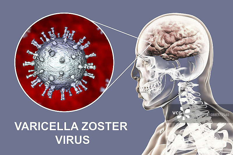 由水痘带状疱疹病毒引起的脑炎，图示图片素材