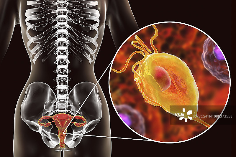 滴虫病，图示图片素材