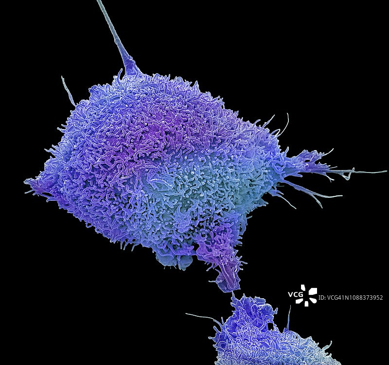 宫颈癌细胞扫描电镜图图片素材