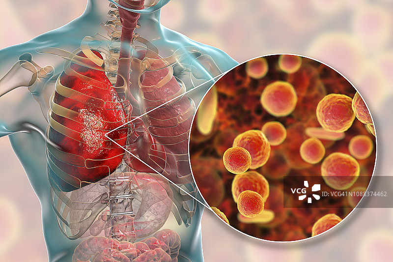 由卡他莫拉菌引起的肺炎插图图片素材