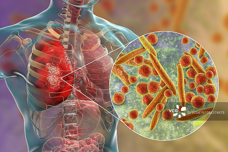 由卡他莫拉菌引起的肺炎插图图片素材