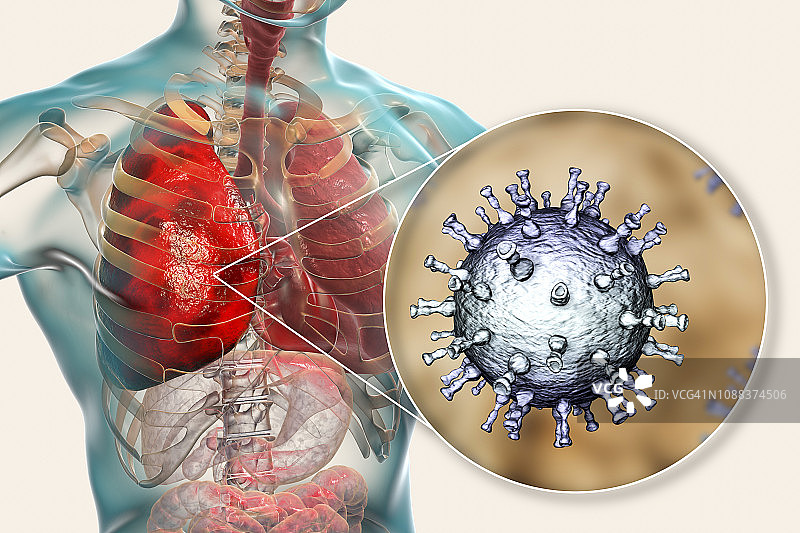 由带状疱疹病毒引起的肺炎图片素材